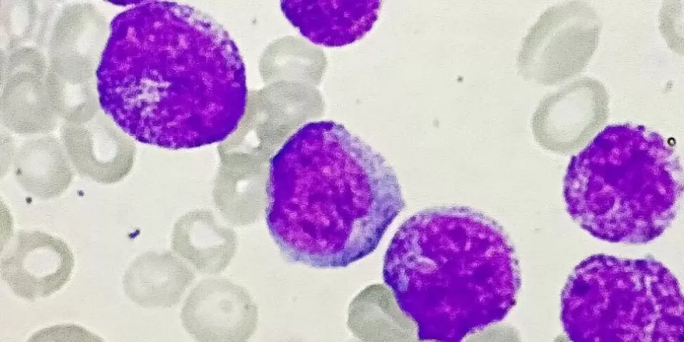 Anemia falciforme nas células